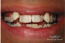 before braces